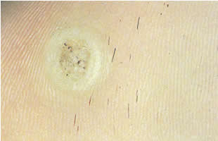 Plantar warts can and should be treated by your podiatrist